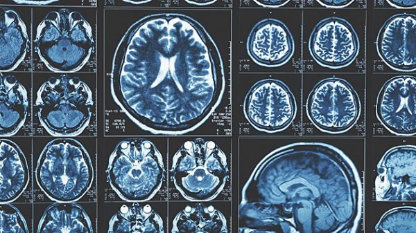 Чем мозг людей с зависимостями от курения, алкоголя или наркотиков отличается от мозга остальных